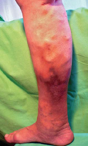 Lipodermatosclerosis a lábszár bőrén és bőr alatti rétegében.