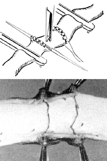 Kivágott thoracalis aortadarab