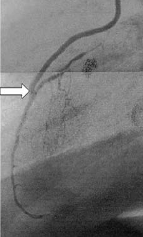 Nitinol kapocs alkalmazása a coronaria sebészetben.