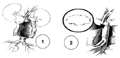  A centralis anastomosis gépi varrata.