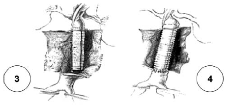 A perifériás anastomosis kézi varrata.