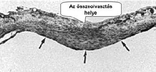 Intimahypertrophia az összeolvasztás helyén