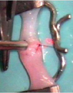 Lézeres microvascularis anatomosis képe digitális artérián