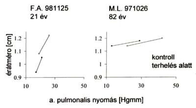 Az arteria pulmonalis rugalmasságának korfüggő változása