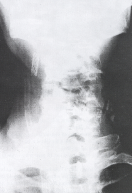 Intraoperatív carotis interna stent implantatio videoangioszkópiás kontroll mellett