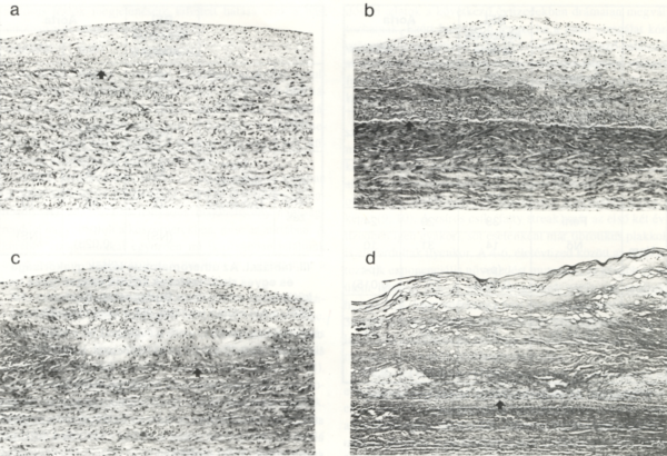 Fiatalkori érelmeszesedés a koszorúerekben és az aortában