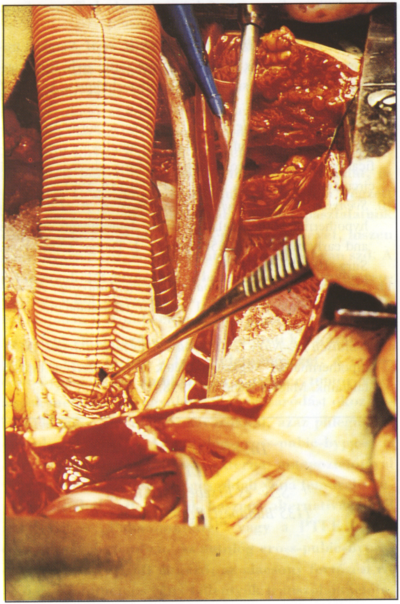 Mérsékelt és mély hipotermia alkalmazása akut aorta ascendens dissectio miatt végzett műtéteknél