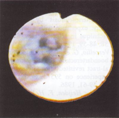 Femoro-poplitealis thrombendarteriectomiák videoangioscopos kontroll mellett