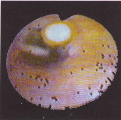 Femoro-poplitealis thrombendarteriectomiák videoangioscopos kontroll mellett