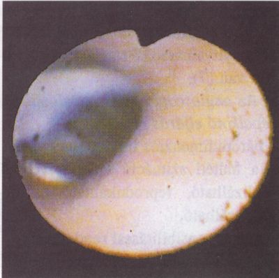 Femoro-poplitealis thrombendarteriectomiák videoangioscopos kontroll mellett