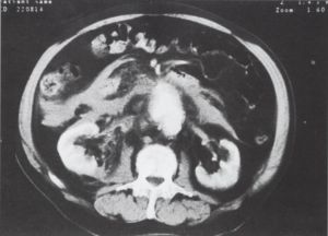 A spirál CT a sürgősségi vascu1aris radiológiában