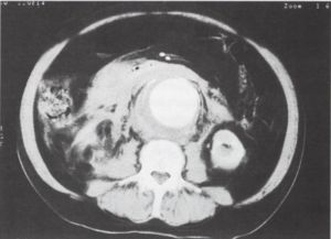 A spirál CT a sürgősségi vascu1aris radiológiában