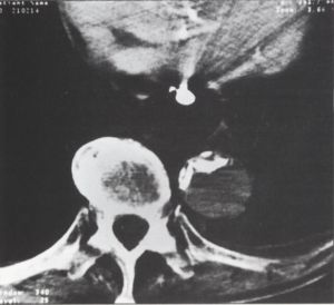 A spirál CT a sürgősségi vascu1aris radiológiában