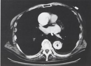 A spirál CT a sürgősségi vascu1aris radiológiában