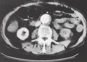 A spirál CT a sürgősségi vascu1aris radiológiában