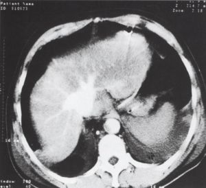 A spirál CT a sürgősségi vascu1aris radiológiában