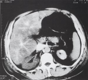 A spirál CT a sürgősségi vascu1aris radiológiában