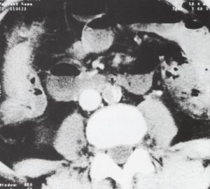 A spirál CT a sürgősségi vascu1aris radiológiában