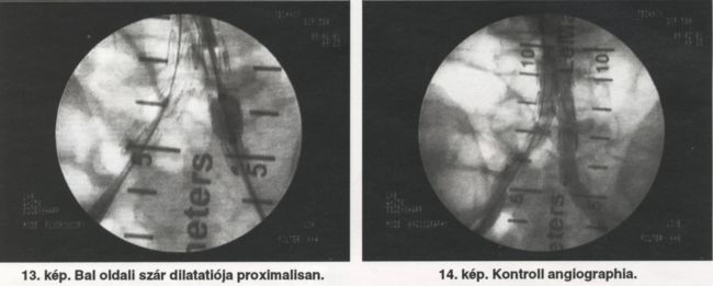 AAA új műtéti megoldása: stentgraft