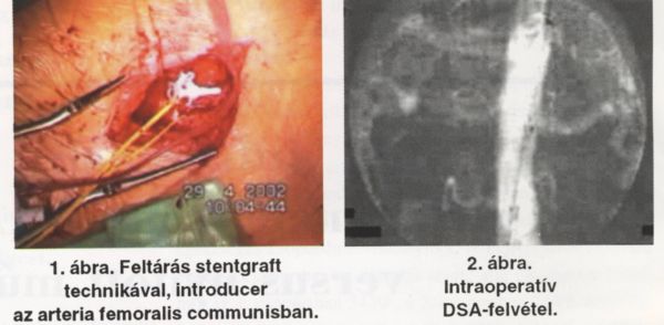 Infrarenalis hasi aorta aneurysma (AAA) stentgraft versus nyitott műtét