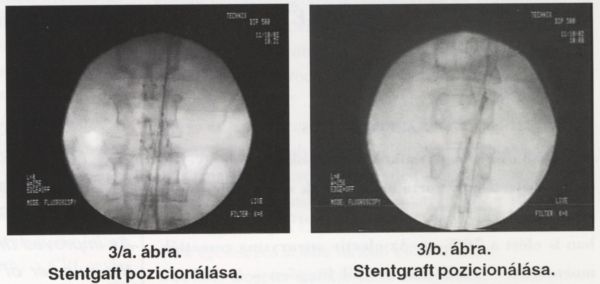 Infrarenalis hasi aorta aneurysma (AAA) stentgraft versus nyitott műtét