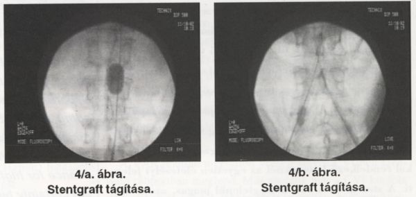 Infrarenalis hasi aorta aneurysma (AAA) stentgraft versus nyitott műtét