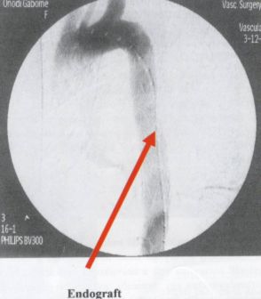 Alimentáris traktusba perforált aorta aneurysmák endovascularis kirekesztése