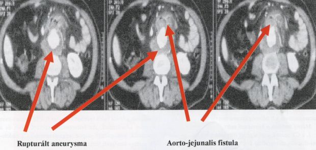 Alimentáris traktusba perforált aorta aneurysmák endovascularis kirekesztése