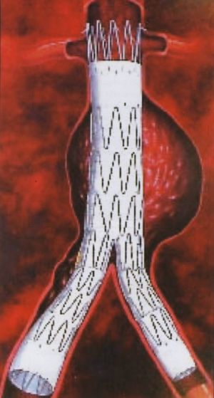 Endovascularis aorta műtéteink eredményei - computer tomográffal végzett 54 hónapos követés