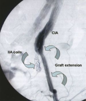 Endovascularis aorta műtéteink eredményei - computer tomográffal végzett 54 hónapos követés
