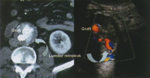 Endovascularis aorta műtéteink eredményei - computer tomográffal végzett 54 hónapos követés