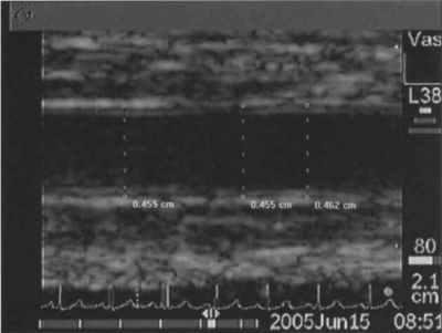 Artéria brachialis flow-mediált vasodilatáció, carotis intima-media vastagság és augmentációs index (AIx) összehasonlító vizsgálata