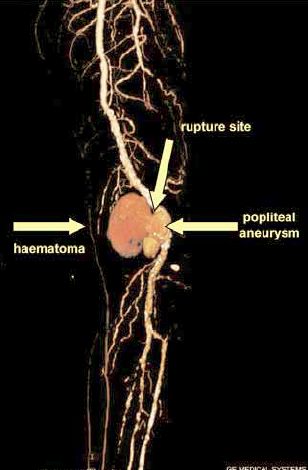 Rupturált mycoticus poplitealis aneurysma endovascularis megoldása