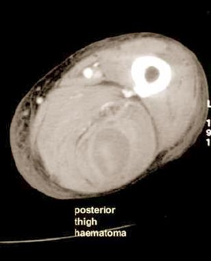 Rupturált mycoticus poplitealis aneurysma endovascularis megoldása