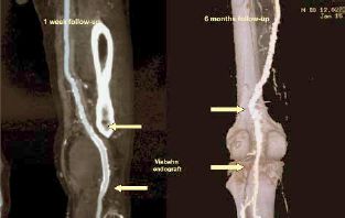 Rupturált mycoticus poplitealis aneurysma endovascularis megoldása