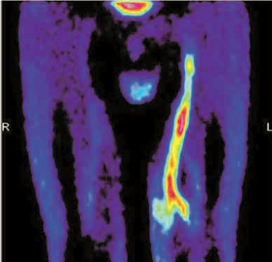 A 18-Fluorodeoxyglucose PET szerepe a graftsuppuratio pontosabb diagnózisában