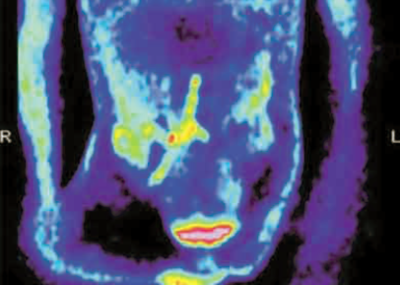 A 18-Fluorodeoxyglucose PET szerepe a graftsuppuratio pontosabb diagnózisában