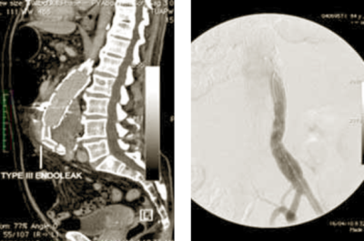 Többszörös endoleak, aorta aneurysmamendoprotézis-műtét után.