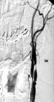 Kétoldali carotis interna szignifikáns szűkületének együléses neurointervenciós kezelése