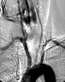 Kétoldali carotis interna szignifikáns szűkületének együléses neurointervenciós kezelése