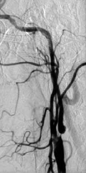 Kétoldali carotis interna szignifikáns szűkületének együléses neurointervenciós kezelése