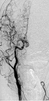 Kétoldali carotis interna szignifikáns szűkületének együléses neurointervenciós kezelése