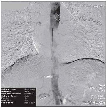 Közép-aorta szindroma kezelése aorto-aorticus bypass műtéttel