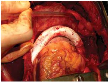 Közép-aorta szindroma kezelése aorto-aorticus bypass műtéttel