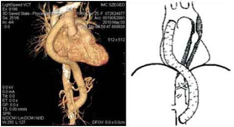 Közép-aorta szindroma kezelése aorto-aorticus bypass műtéttel