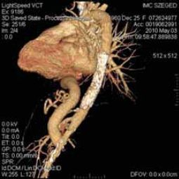 Közép-aorta szindroma kezelése aorto-aorticus bypass műtéttel