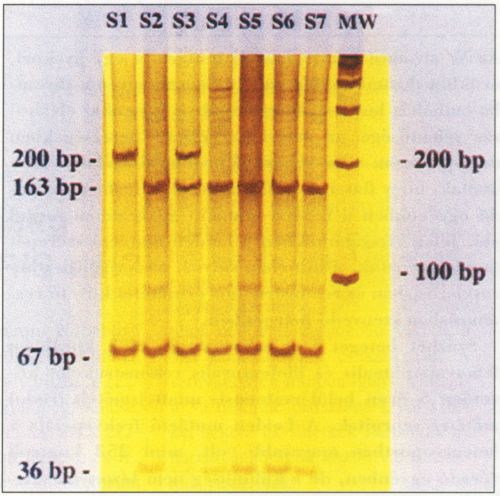 Factor V.Leiden genotípus súlyos, poplitealis restenosissal járó atherosclerosisban
