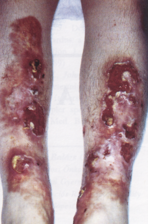 A lábszárfekély differenciál diagnosztikája