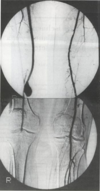Acut alsó végtagi ischaemiát okozó artéria poplitea álaneurysma sikerrel operált esete