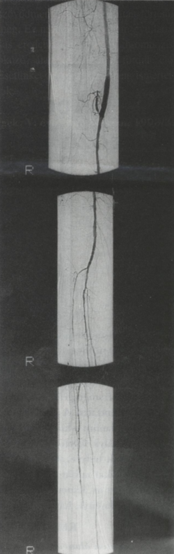 Acut alsó végtagi ischaemiát okozó artéria poplitea álaneurysma sikerrel operált esete